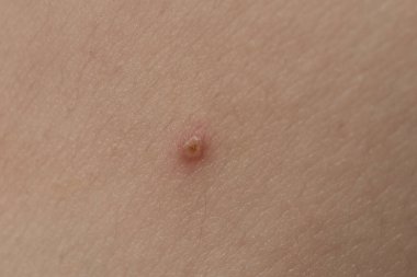 Cilt tedavisi. Cilt bakımı sorunu. Sivilce kapağı. Sivilce ve sivilce. Cilt bakımı. Dermatoloji cilt bakımı. Ergenlik çağındaki kadın. Sivilce problemi. Deri dokusu. Yakın akne derisi.