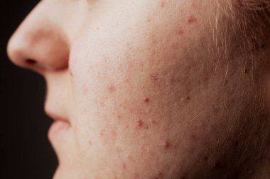 Cilt dokusu kötü. Sivilceli sivilce. Cilt tedavisi. Cilt bakımı sorunu. Sivilceler, sivilceler, gözenekler, yaralar. Doğal cilt. Cilt bakımı. Sivilce tedavisi. Deride sivilceler. Kozmetoloji