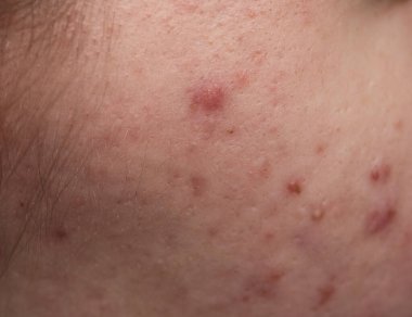 Bir sürü sivilce. Kötü cilt. Hormonal sivilce, ergenlik. Deri sivilcesi arka planı. Sivilceli sivilceler. Sivilce derisi tedavisi. Cilt bakımı sorunu. Sivilceler, gözenekler, yaralar Cilt bakımı