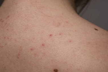 Sivilce kapağı. Deri dokusu. Yakın akne derisi. Cilt tedavisi. Cilt bakımı sorunu. Sivilce tedavisi. Yüzünde ve vücudunda sivilceler