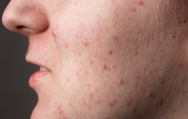 Sivilce. Cilt bakımı sorunu. Sivilceler, sivilceler, gözenekler, yaralar. Doğal cilt. Cilt bakımı. Yüzünde sivilceler. Sivilce kapağı. Dermatoloji cilt bakımı. Ergenlik çağındaki kadın. Sivilce problemi