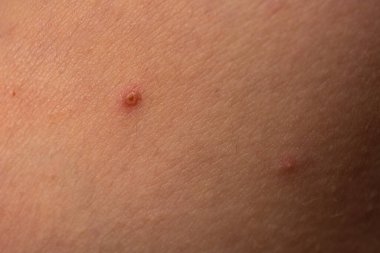 Deri arkaplanı. Sivilceli sivilceler. Cilt tedavisi. Cilt bakımı sorunu. Sivilceler, sivilceler, gözenekler. Doğal cilt. Deri bakımı konsepti. Sivilce tedavisi. Yüzünde sivilceler. Sivilce ve sivilce