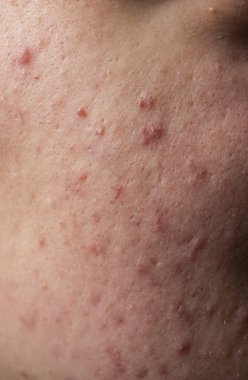 Dermatolojik sivilceler. Deri dokusu arka planı. Sivilceli sivilceler. Cilt bakımı sorunu. Sivilceler, sivilceler, gözenekler, yaralar. Doğal cilt. Deri bakımı konsepti. Sivilce tedavisi. Deride sivilceler