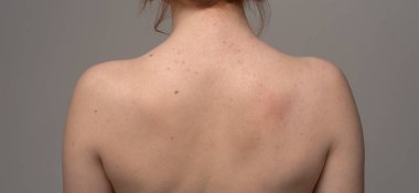 Deri dokusu arka planı. Sırtında sivilce var. Cilt tedavisi. Cilt bakımı sorunu. Sivilceler ve doğal deri. Deri bakımı konsepti. Sivilce tedavisi. Yüzünde sivilceler. Sivilce ve sivilce.