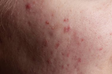 Dermatoloji problemleri. Sivilce, sivilce, deride yara, yüz problemi. Kötü cilt. Yüzünde kızarıklık var. Yüzünde sivilce izi var. Deride sorun var. Sivilce, sivilce, gözenek
