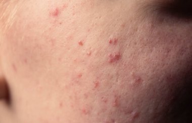 Dermatolojik sivilceler. Deri dokusu arka planı. Sivilceli sivilceler. Cilt bakımı sorunu. Sivilceler, sivilceler, gözenekler, yaralar. Doğal cilt. Deri bakımı konsepti. Sivilce tedavisi. Deride sivilceler