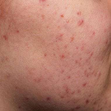 Bir sürü sivilce. Kötü cilt. Hormonal sivilce, ergenlik. Deri sivilcesi arka planı. Sivilceli sivilceler. Sivilce derisi tedavisi. Cilt bakımı sorunu. Sivilceler, gözenekler, yaralar Cilt bakımı