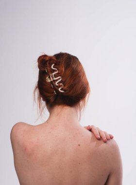 Kızarıklık. Dermatoloji. Kaşındırıyor. Sırtını kaşıyan kadın. Kızarıklık. Dermatoloji. Kaşındırıyor, kaşındırıyor ya da deri döküntüsü yapıyor. Cilt bakımı, cilt tedavisi