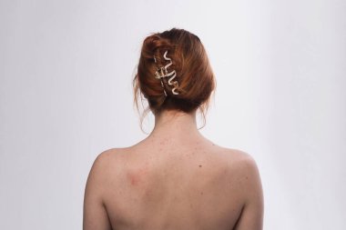 Sivilce geçmişi. Deri dokusu. Sırtında sivilce var. Cilt tedavisi. Cilt bakımı sorunu. Sivilceler ve doğal deri. Deri bakımı konsepti. Sivilce tedavisi. Yüzünde sivilceler. Sivilce ve sivilce.