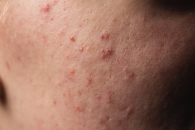 Dermatolojik sivilceler. Deri dokusu arka planı. Sivilceli sivilceler. Cilt bakımı sorunu. Sivilceler, sivilceler, gözenekler, yaralar. Doğal cilt. Deri bakımı konsepti. Sivilce tedavisi ciltte sivilceler