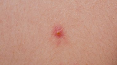 Sivilce sivilcesi. Deri dokusu arka planı. Sivilceli sivilceler. Cilt bakımı sorunu. Sivilceler, sivilceler, gözenekler, yaralar. Doğal cilt. Deri bakımı konsepti. Sivilce tedavisi ciltte sivilceler