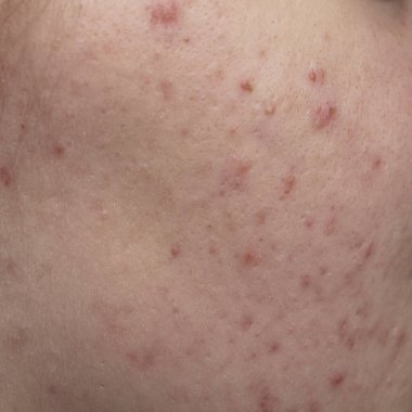 Bir sürü sivilce. Kötü cilt. Hormonal sivilce, ergenlik. Deri sivilcesi arka planı. Sivilceli sivilceler. Sivilce derisi tedavisi. Cilt bakımı sorunu. Sivilceler, gözenekler, yaralar Cilt bakımı