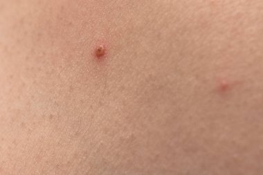 Sivilce kapağı. Deri dokusu. Yakın akne derisi. Cilt tedavisi. Cilt bakımı sorunu. Sivilce tedavisi. Yüzünde ve vücudunda sivilceler