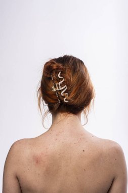 Sırtında sivilce var. Deri sivilcesi arka planı. Sırtında sivilceler var. Sırtında sivilce var. Dermatoloji ve kozmetoloji. Pezevenk. Hassas bir cilt. Akne derisi