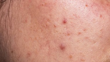 Sivilceler. Kötü cilt. Hormonal sivilce, ergenlik. Deri sivilcesi arka planı. Sivilceli sivilceler. Sivilce derisi tedavisi. Cilt bakımı sorunu. Sivilceler, gözenekler, yaralar Cilt bakımı