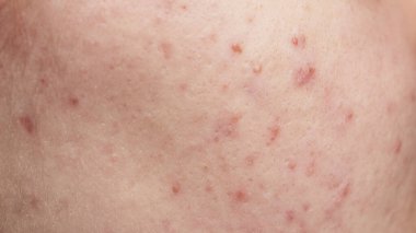 Bir sürü sivilce. Kötü cilt. Hormonal sivilce, ergenlik. Deri sivilcesi arka planı. Sivilceli sivilceler. Sivilce derisi tedavisi. Cilt bakımı sorunu. Sivilceler, gözenekler, yaralar. Cilt bakımı