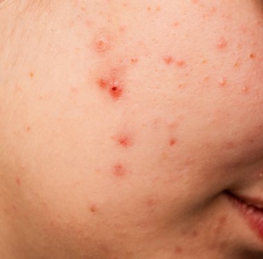 Bir sürü sivilce. Cildi kötü olan kız. Hormonal sivilce, ergenlik. Deri sivilcesi arka planı. Sivilceli sivilceler. Sivilce derisi tedavisi. Cilt bakımı sorunu. Sivilceler, gözenekler, yaralar. Cilt bakımı