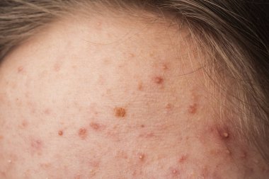 Deri sivilcesi arka planı. Sivilceli sivilceler. Sivilce derisi tedavisi. Cilt bakımı sorunu. Sivilceler, sivilceler, gözenekler, yaralar. Doğal cilt. Cilt bakımı. Yüzünde sivilceler