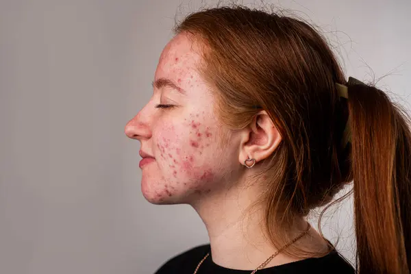 Bir sürü sivilce. Cildi kötü olan kız. Hormonal sivilce, ergenlik. Deri sivilcesi arka planı. Sivilceli sivilceler. Sivilce derisi tedavisi. Cilt bakımı sorunu. Sivilceler, gözenekler, yaralar. Cilt bakımı