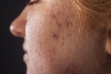 Sivilce ve sivilce. Cilt bakımı. Sivilce kapağı. Dermatoloji cilt bakımı. Sivilce problemi. Deri dokusu arka planı. Sivilceli sivilceler. Cilt tedavisi. Cilt bakımı sorunu. Sivilceler