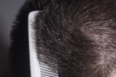 Dermatoloji şampuanı. Deri iltihabı veya egzama. Kepek problemi. Kepek kılı. Dağınık saçlar. Kepekli saçlar. Kafa derisi problemi, kepek. Saç dökülmesi hastalığı.