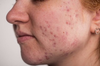 Bir sürü sivilce. Cildi kötü olan kız. Hormonal sivilce, ergenlik. Deri sivilcesi arka planı. Sivilceli sivilceler. Sivilce derisi tedavisi. Cilt bakımı sorunu. Sivilceler, gözenekler, yaralar. Cilt bakımı