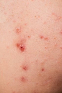 Sivilceli sivilceler. Cilt tedavisi. Cilt bakımı sorunu. Sivilceler. Sivilce kapağı. Sivilce ve sivilce. Cilt bakımı. Dermatoloji cilt bakımı. Sivilce problemi. Deri dokusu arkaplanı