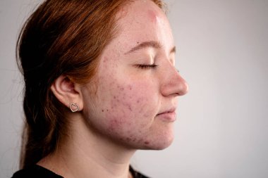 Deri sivilcesi arka planı. Sivilceli sivilceler. Sivilce derisi tedavisi. Cilt bakımı sorunu. Sivilceler, sivilceler, gözenekler, yaralar. Doğal cilt. Cilt bakımı. Yüzünde sivilceler