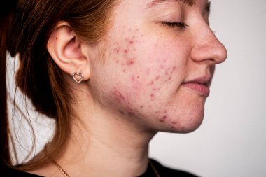 Deri dokusu arka planı. Sivilceli sivilceler. Cilt tedavisi. Cilt bakımı sorunu. Sivilceler, sivilceler, gözenekler, yaralar. Doğal cilt. Deri bakımı konsepti. Sivilce tedavisi. Yüzünde sivilceler. Sivilce ve sivilce