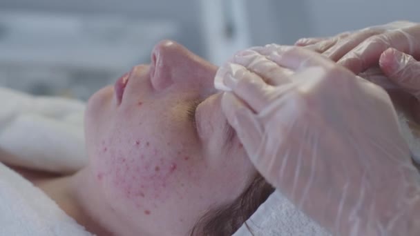Kozmetik Uzmanının Randevusunda Derisi Sorunlu Bir Kadın Yüzünü Pamukla Siliyor — Stok video