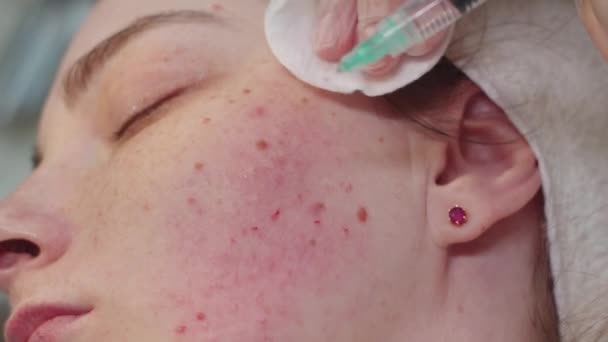 Bir Dermatologla Seans Terapist Yanak Derisinin Altına Bir Solüsyon Enjekte — Stok video