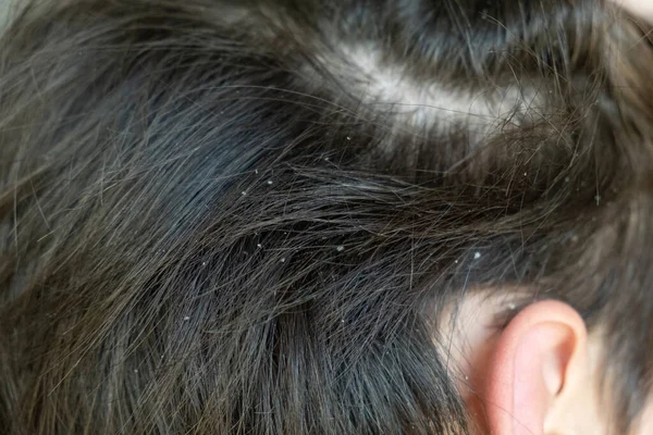Πιτυρίδα Παιδικά Μαλλιά Τριχωτό Της Κεφαλής Παιδική Πιτυρίδα Σμηγματορροϊκή Δερματίτιδα — Φωτογραφία Αρχείου