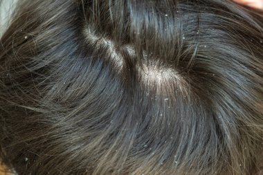 Çocuk saçında kepek. Sarkık kafa derisi. Çocuklar için kepek. Seborrheic dermatitis. Kafa derisinde ve saçında beyaz pullar var..