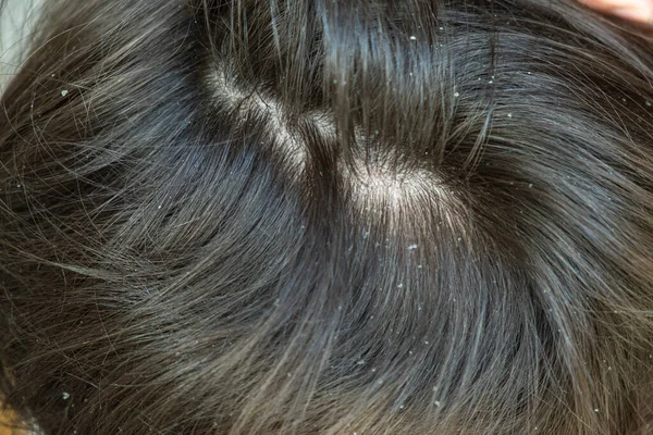 Dandruff Kid Hair Flaky Scalp Childrens Dandruff Seborrheic Dermatitis White — Stock Photo, Image