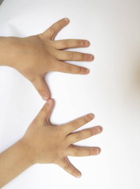 Deri iltihabı olan bir çocuk eli. Ellerinde egzama var. Beyaz arka planda izole edilmiş. Kabuk soyma.