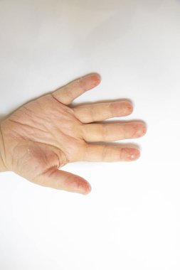 Deri iltihabı olan bir çocuk eli. Ellerinde egzama var. Beyaz arka planda izole edilmiş. Kabuk soyma.