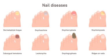 Tırnak hastalıkları, mantar enfeksiyonları. Onychomycosis, onycholysis. Tırnakların sorunlu ayak tırnağı temsili