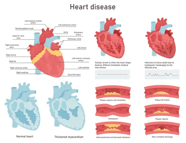 Kalp hastalığı illüstrasyonu. Kalp sorunları var. Kalp krizi ve kalp krizi, miyokardit. Kardiyoloji bilgisi