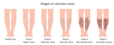 Varisli damarların aşamaları. Kadınlardaki varis damarları. Sağlıklı ve hastalıklı bacakların görüntüsü. Varisli bilgi aktarımı