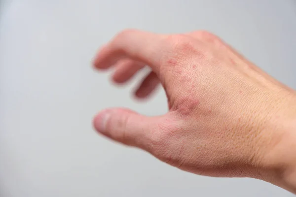 Allergisk Reaktion Röda Utslag Kliar Handen Orsakad Väder Eller Svamp — Stockfoto