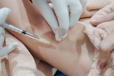 Cilt bakterisi kliniğinde vücut kokusunu ve kırışıklıkları azaltmak için koltukaltına şırınga bakteriyel botulin enjekte eden bir tıp uzmanının yakınlaşması.