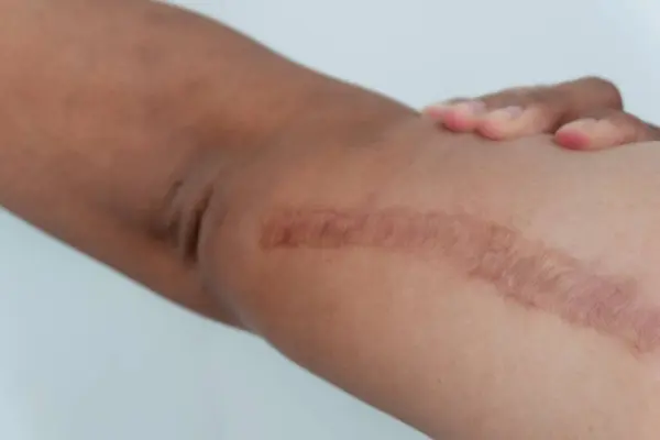 Sarcoptes adı verilen akarların deri altına kazdığı deri enfeksiyonu, bacak derisinden çıkan kabarcık lekesi..