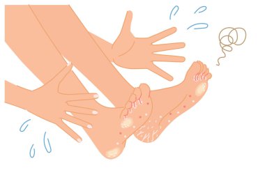 Ayaklarında atlet ayağı, nasırları ve nasırları ile şaşırmış bir kadın tasviri (vücut parçaları))