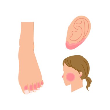 Illustrations of areas where chilblains often occur (feet, ears, cheeks) clipart