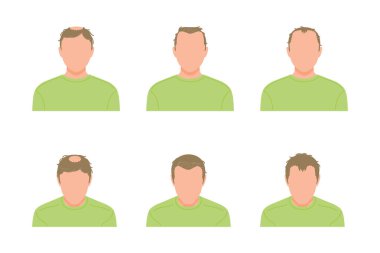 Önden görünen seyrelen saçlı bir adamın basit bir simgesi.