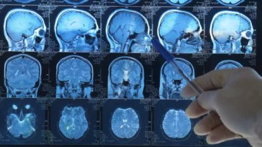 Doktor MRI görüntüsünde hastanın beyninde anormallikler gösteriyor. Doktor röntgende hastanın beynine bakar. Yavaş çekim