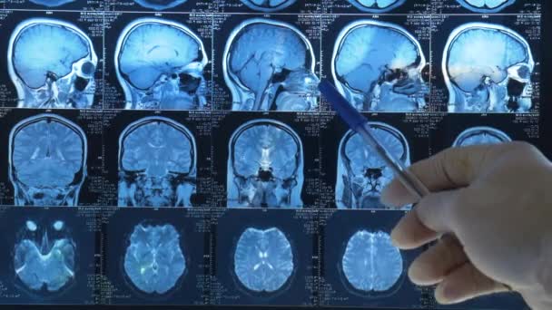 Médico Mostra Anormalidades Cérebro Paciente Uma Imagem Médico Olha Para — Vídeo de Stock