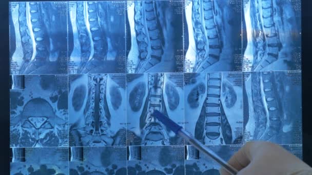 医師は Mriスキャンの患者の脊椎の異常 問題を示しています 医師はX線上の患者の背骨を見る — ストック動画