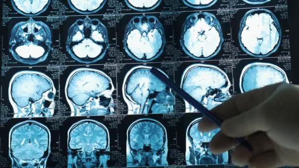 Doktor Retgen Üzerinde Hastanın Beynindeki Sorunları Gösteriyor Röntgende Doktor Hastanın — Stok video