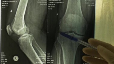 Bir doktor röntgenlerde hastanın diz ekleminde anormallikler gösteriyor. Doktor, hastanın dizine röntgende bakıyor. Yavaş çekim
